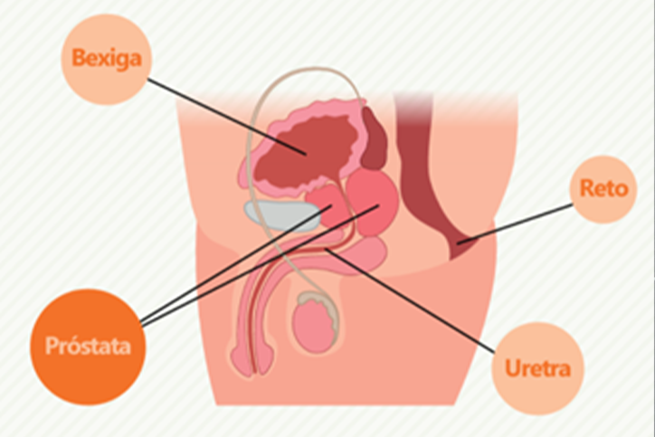 câncer de próstata